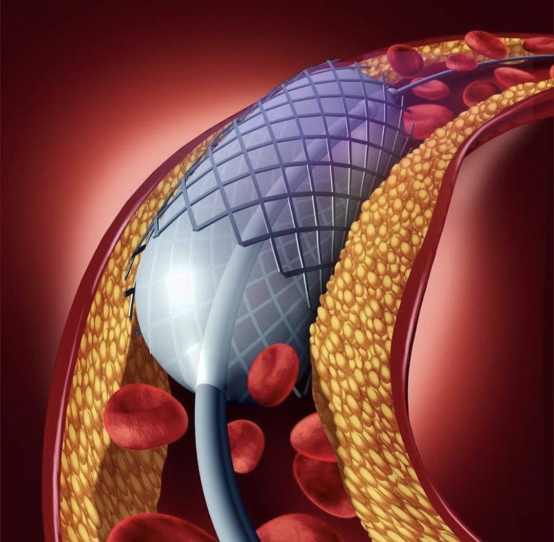 Balón y stent dentro de la arteria coronaria