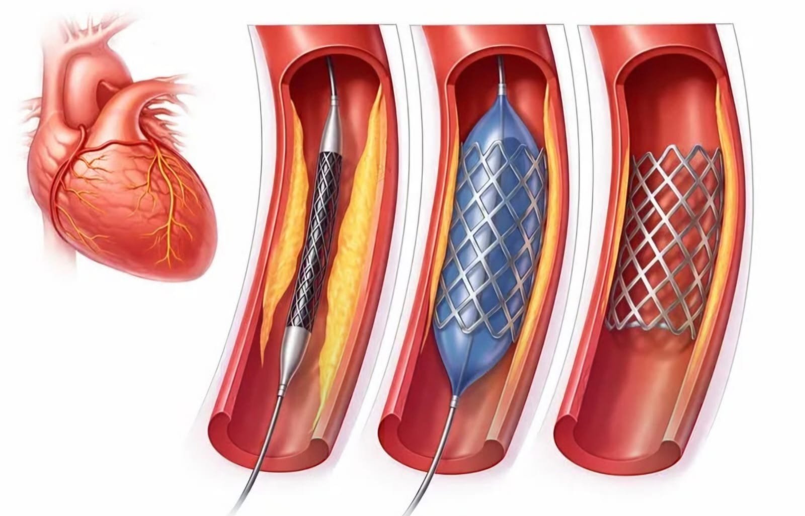 Colocación de stent coronario — cardiología intervencionista